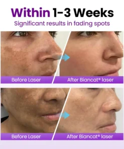 Biancat® SpotErase Probiotic Shield Serum