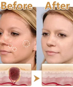 Biancat® BeeVenom Wart Drop Serum