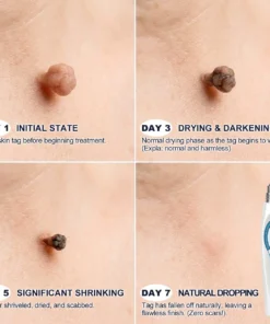 Biancat® 7-Day Skin Tag & Spot Eraser Painless & Scar-Free Advanced Imperfection Removal Rollerball Pen