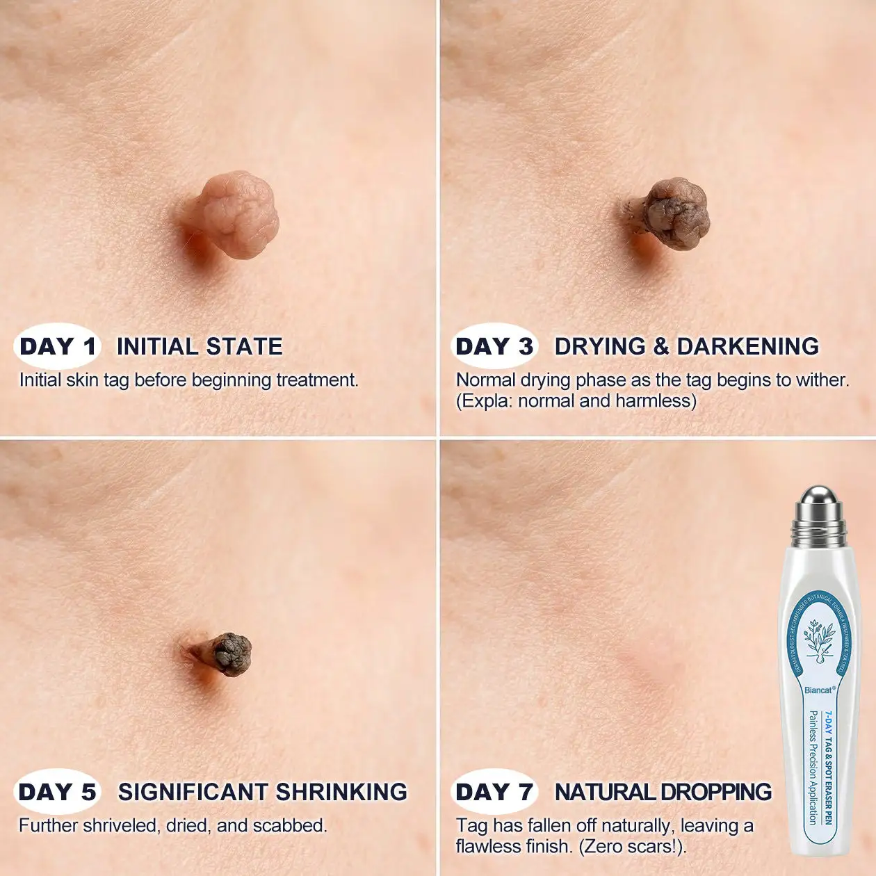 Biancat® 7-Day Skin Tag & Spot Eraser Painless & Scar-Free Advanced Imperfection Removal Rollerball Pen
