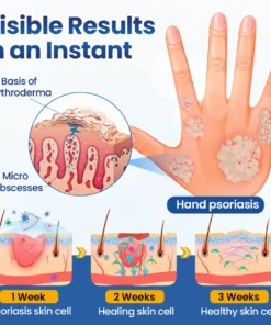 Biancat® PsoriaMucin No-Rub Itch & Flake Relief Mist