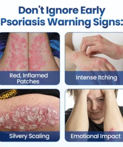 Biancat® PsoriaMucin No-Rub Itch & Flake Relief Mist