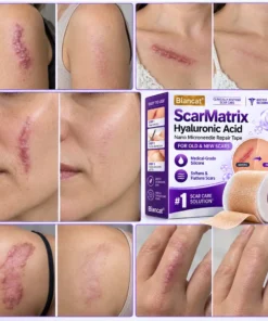 Biancat® ScarMatrix Hyaluronic Acid Nano Microneedle Repair Tape