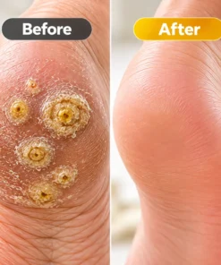 Biancat® BeeClear Wart & Corn Renewal Cream